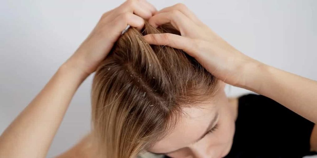 dandruff dilemma
