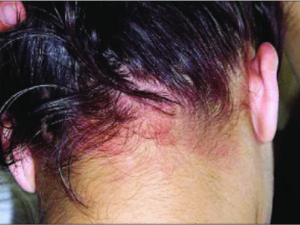 Allergy Reactions on Hair Skin Allergy Reactions on Hair Skin