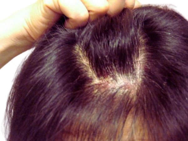 Scalp Irritation Scalp Irritation